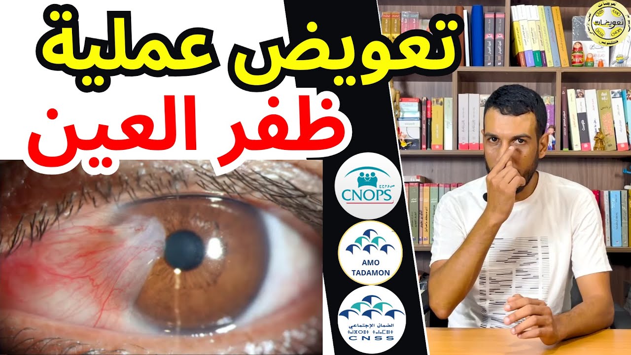 عملية ظفر العين | تعويض  كنوبس سنيسيس الضمان الاجتماعي امو تضامن الشامل | Ptérygion CNOPS CNSS AMO