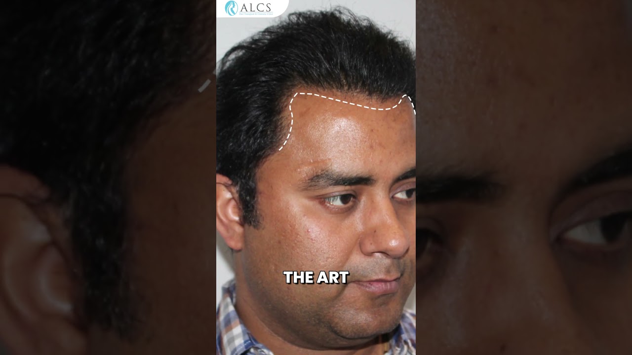 Hair Transplant Is Art | Dr. Sunil Arora&rsquo;s Precision Technique Reveal