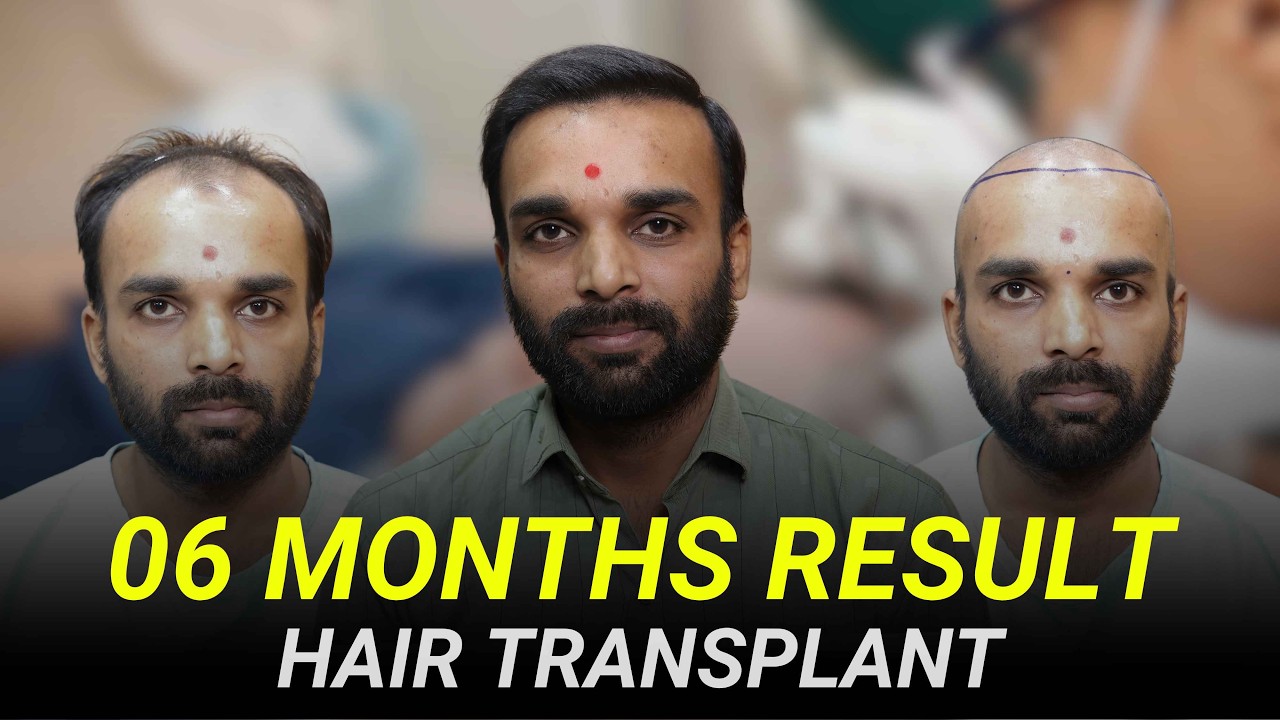 Hair Transplant 6 months Result | Hair Transplant Before and After | Donor Area Recovery