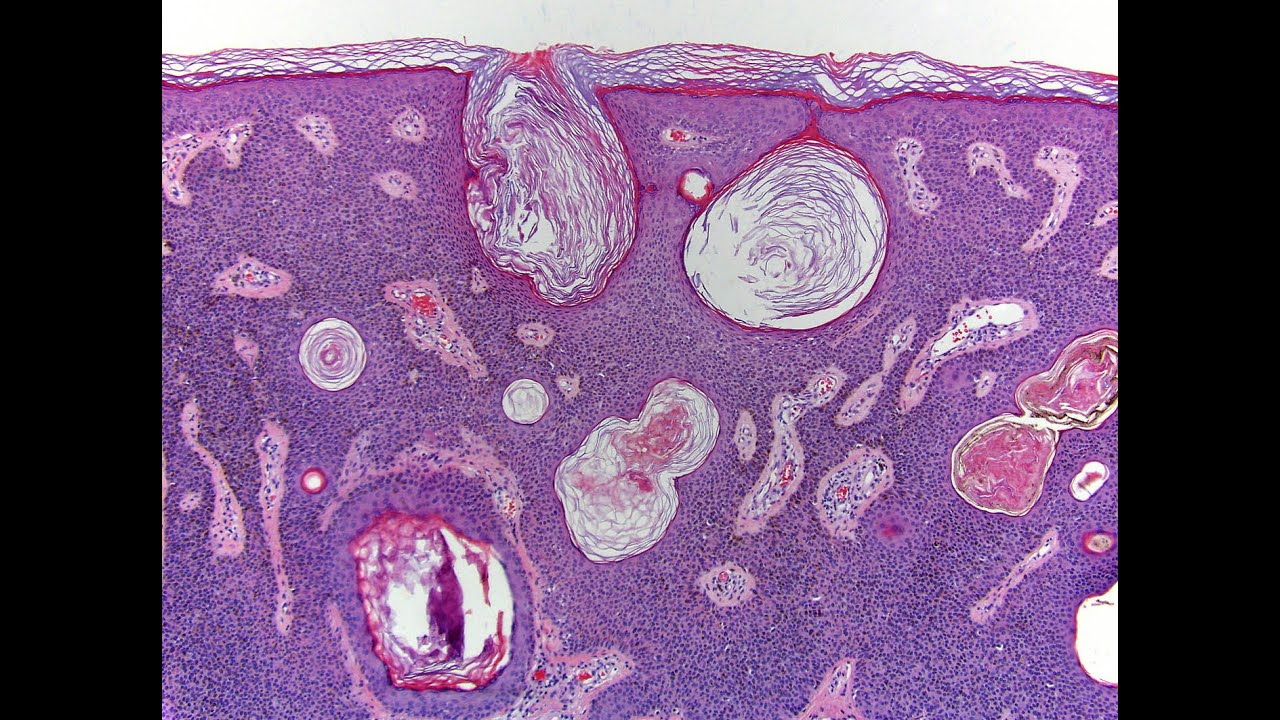 Benign epidermal neoplasms Part 1 (lentigo / seborrheic keratoses)