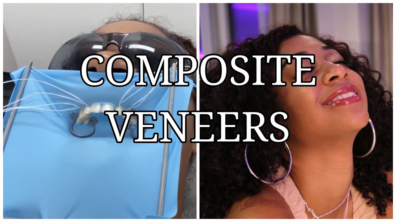 I GOT VENEERS FOR CHEAP - COMPOSITE BONDING EXPERIENCE