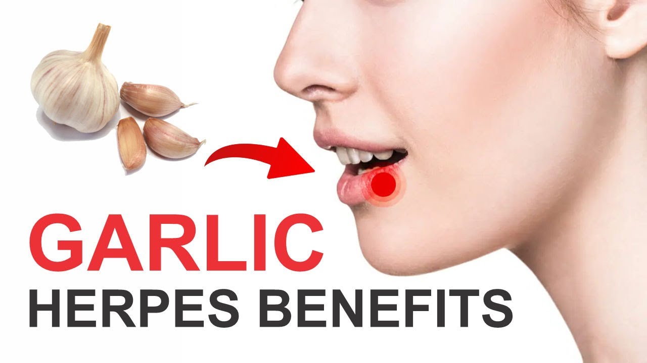 Garlic Herpes Benefits