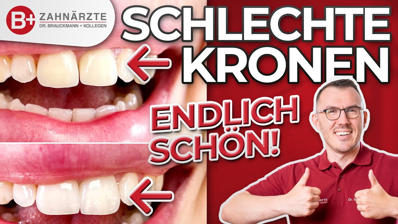 Schlechte Zahnkronen auf Schneidezähnen ÄSTHETISCH gestalten! Endlich schöne Frontzahn-Kronen!