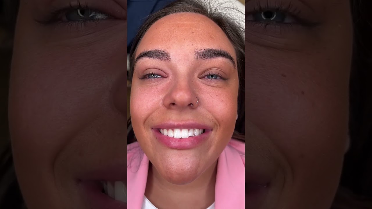 The minimally invasive smile makeover with teeth whitening and composite bonding💯