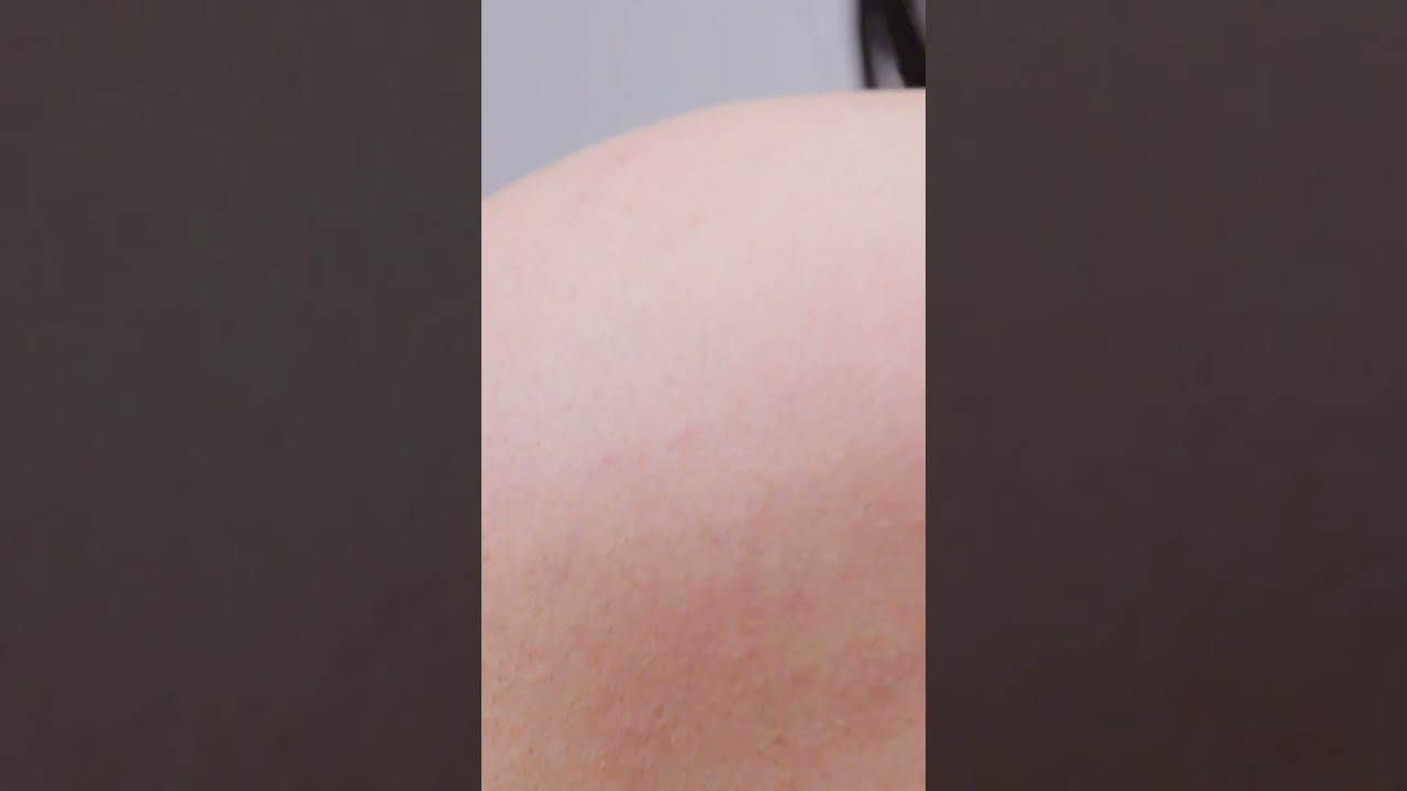 Sarra vive com um lipoma no ombro há 10 anos 🩺 