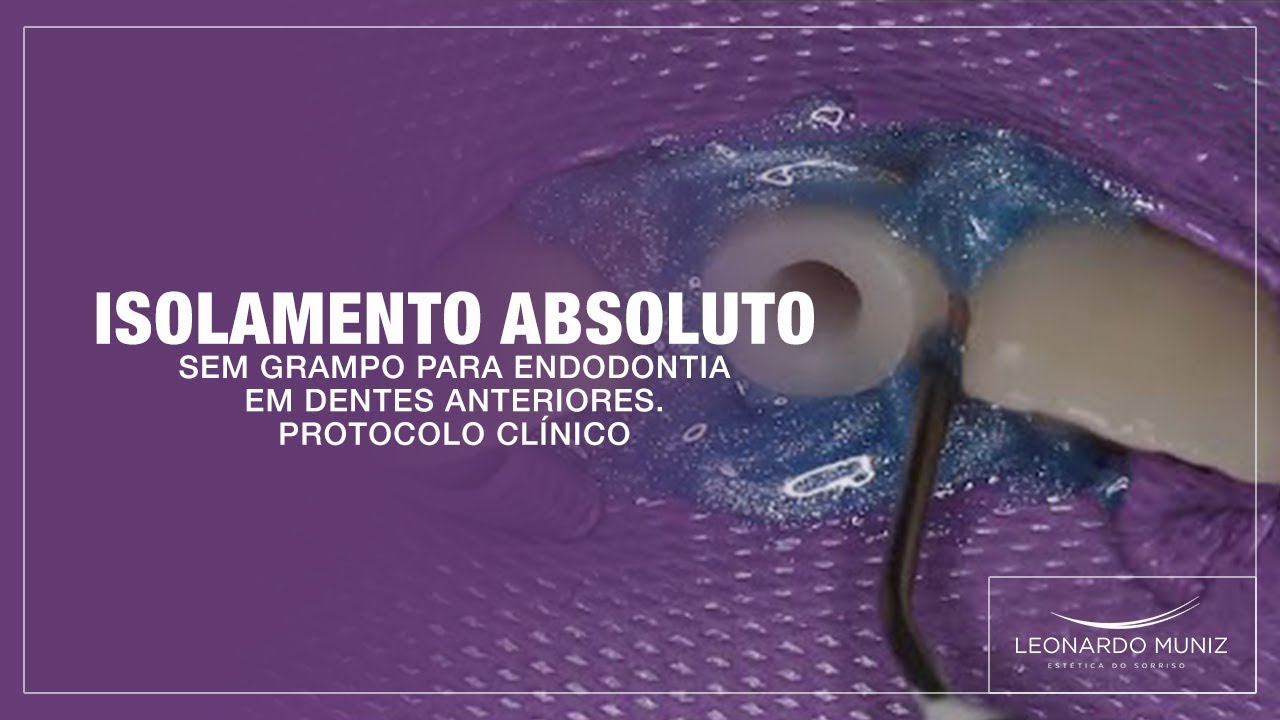 Isolamento Absoluto sem Grampo para Endodontia em Dentes Anteriores. Protocolo Clínico