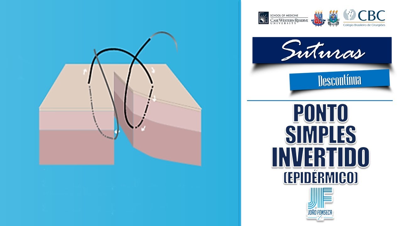 🪡SUTURAS – PONTO SIMPLES INVERTIDO (EPIDÉRMICO) OU SWIFT