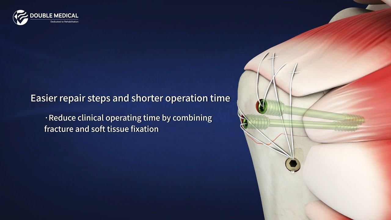 Double Medical Cannulated Anchor Screws System (CASS) - Features and Surgical Technique