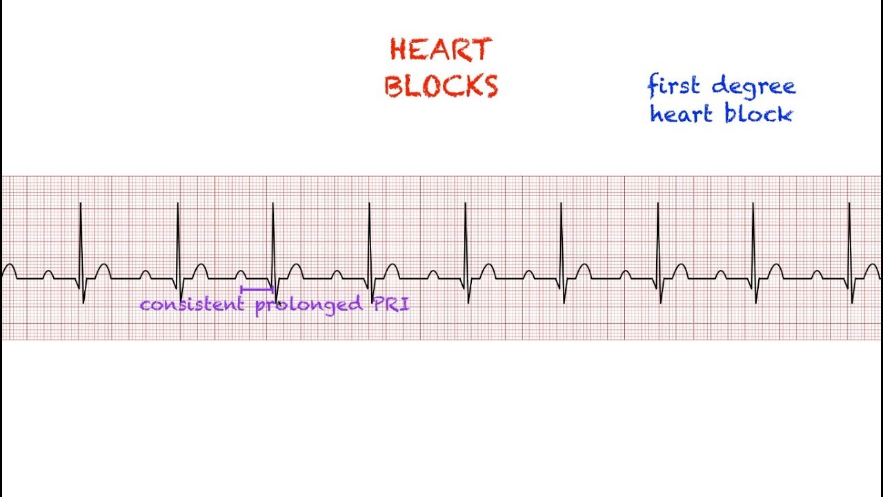 Heart Blocks Interpretation: Easy and Simple