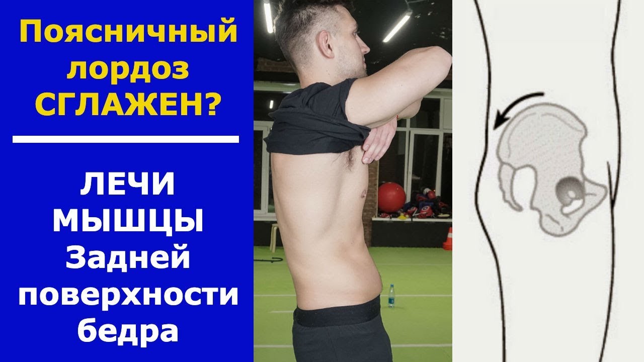Почему поясничный лордоз выпрямлен. Как его восстановить?