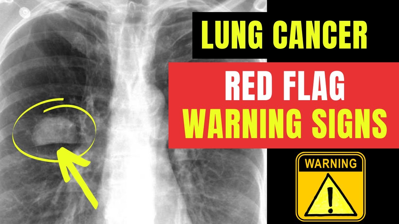 How to spot RED FLAG warning signs & symptoms of LUNG CANCER... Doctor O'Donovan explains