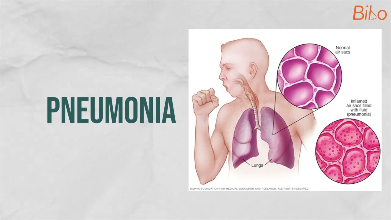 Easy steps to recover from Pneumonia