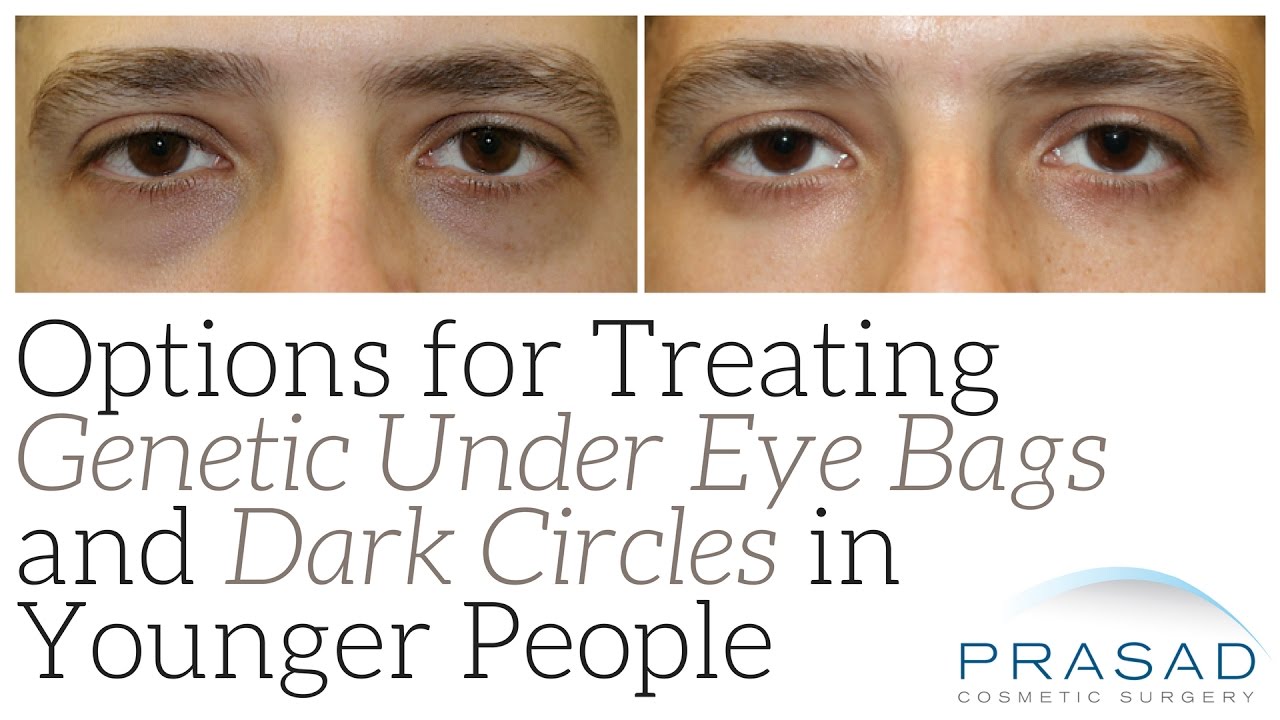 How Genetic Eye Bags and Dark Circles can be Treated in Younger People