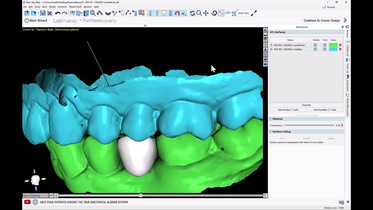 BSP 4.13: Crown for Titanium Base Abutment. AI Automatic Tooth Design. Design and Export Free!