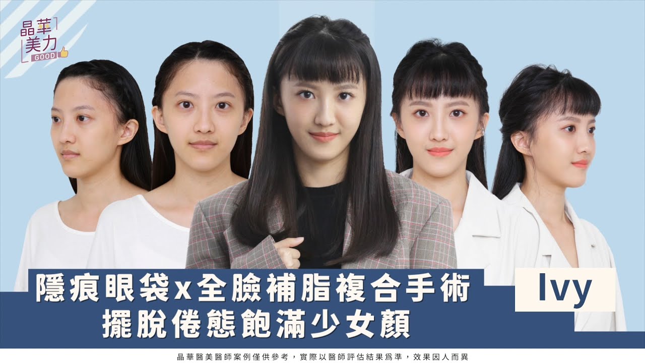 全臉精雕案例｜隱痕眼袋全臉補脂複合手術案例分享！誰說眼袋只能靠遮瑕？膠原蛋白流失怎麼辦？內開眼袋與外開眼袋手術的差別是？一招教你完美消滅眼袋、淚溝、凹陷老態！｜晶華美醫診所 鄭穎醫師 台北整形推薦