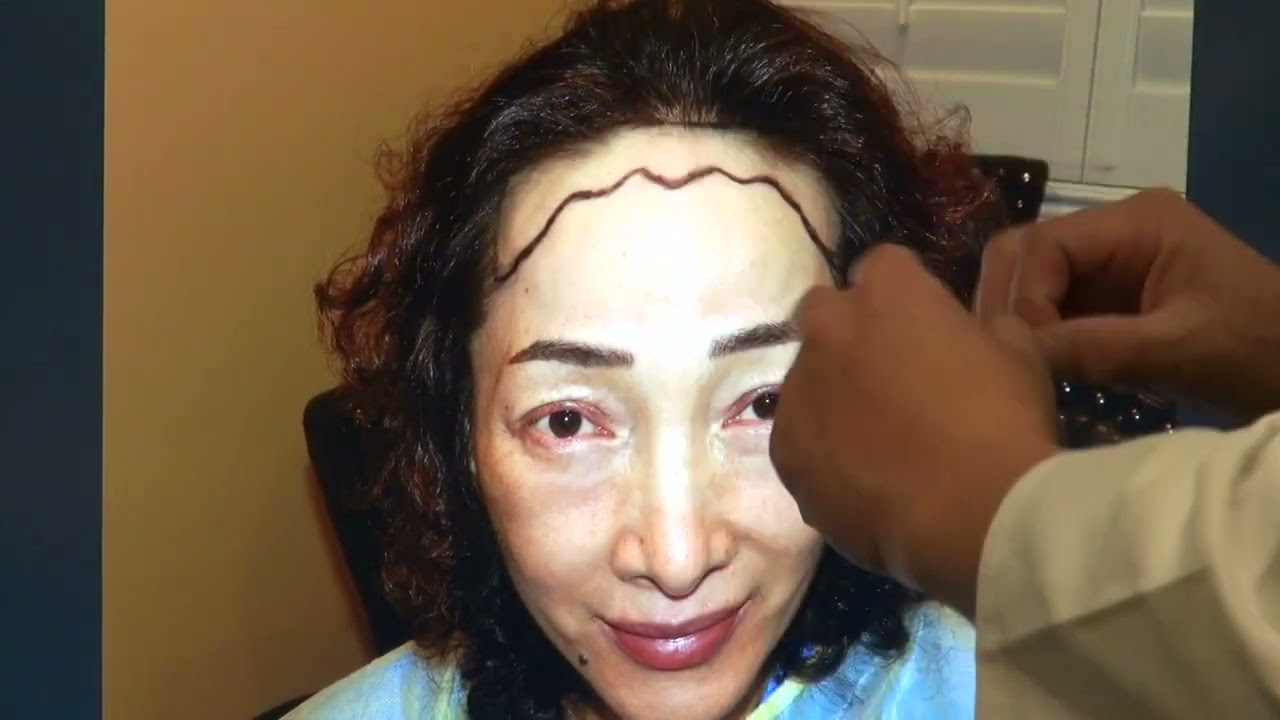 1 Year Female Hair Transplant Result | High Hairline Correction & Full Density Reveal
