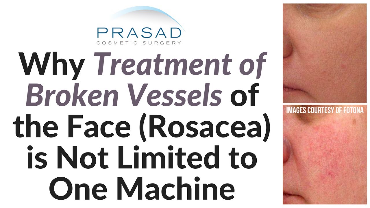 Why Broken Vessels in the Face can be Treated by More than One Type of Machine