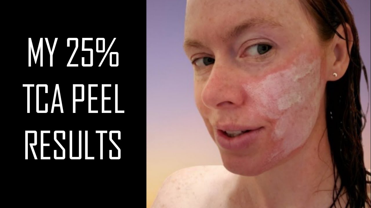 25% TCA PEEL RESULTS ** For Freckles, Hyperpigmentation & Acne Scarring **