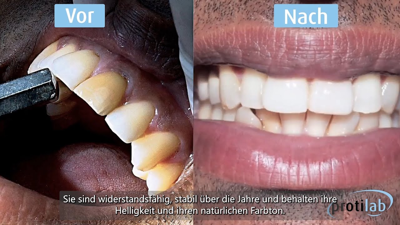 Produktratgeber: Ultrad&uuml;nne easyfit&reg;-Veneers e.max&reg;