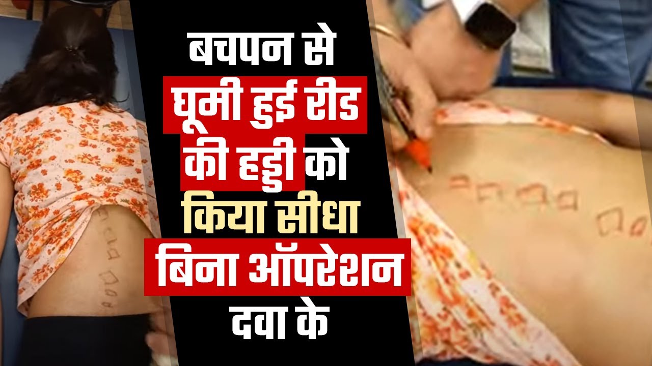 बचपन से घूमी हुई रीड की हड्डी को किया सीधा बिना ऑपरेशन दवा के Dr. Varun duggal P.T