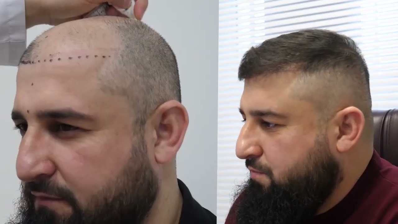 Пересадка волос. Цена просто шикарная 😱