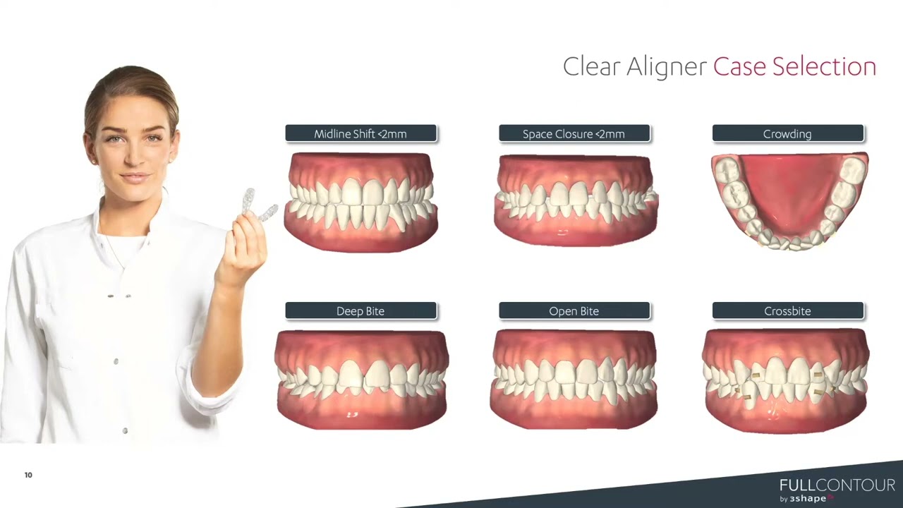 3Shape Design Service - How to be Successful with in-house Aligners