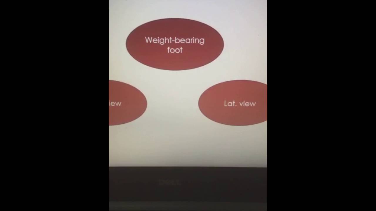 pes planovalgus