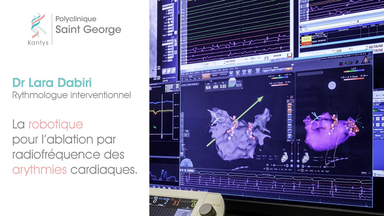 [RYTHMOLOGIE] La robotique pour l'ablation par radiofréquence des arythmies cardiaques