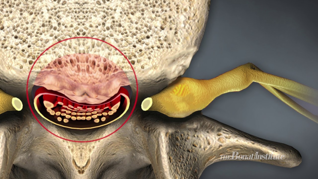 Spinal Stenosis, Causes and Treatment