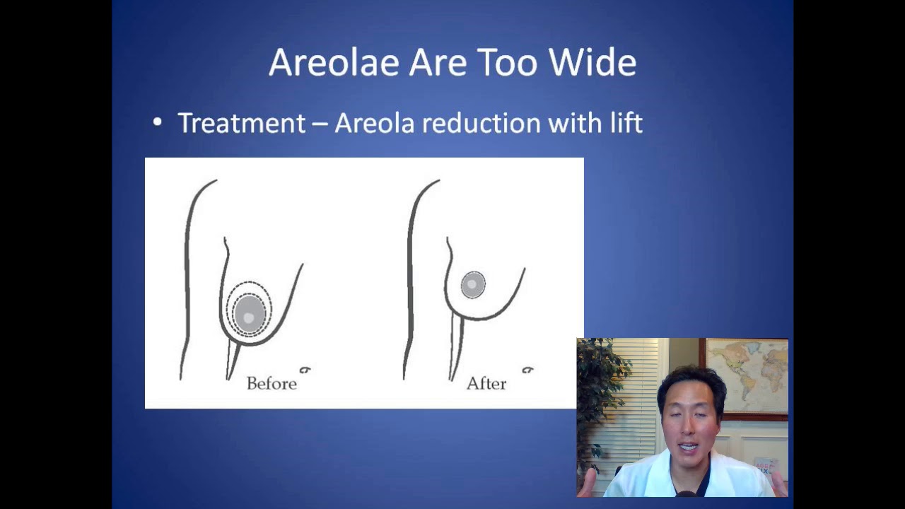 How Can I Fix Wide Areolas - Areola Surgery Consultation - Dr. Anthony Youn