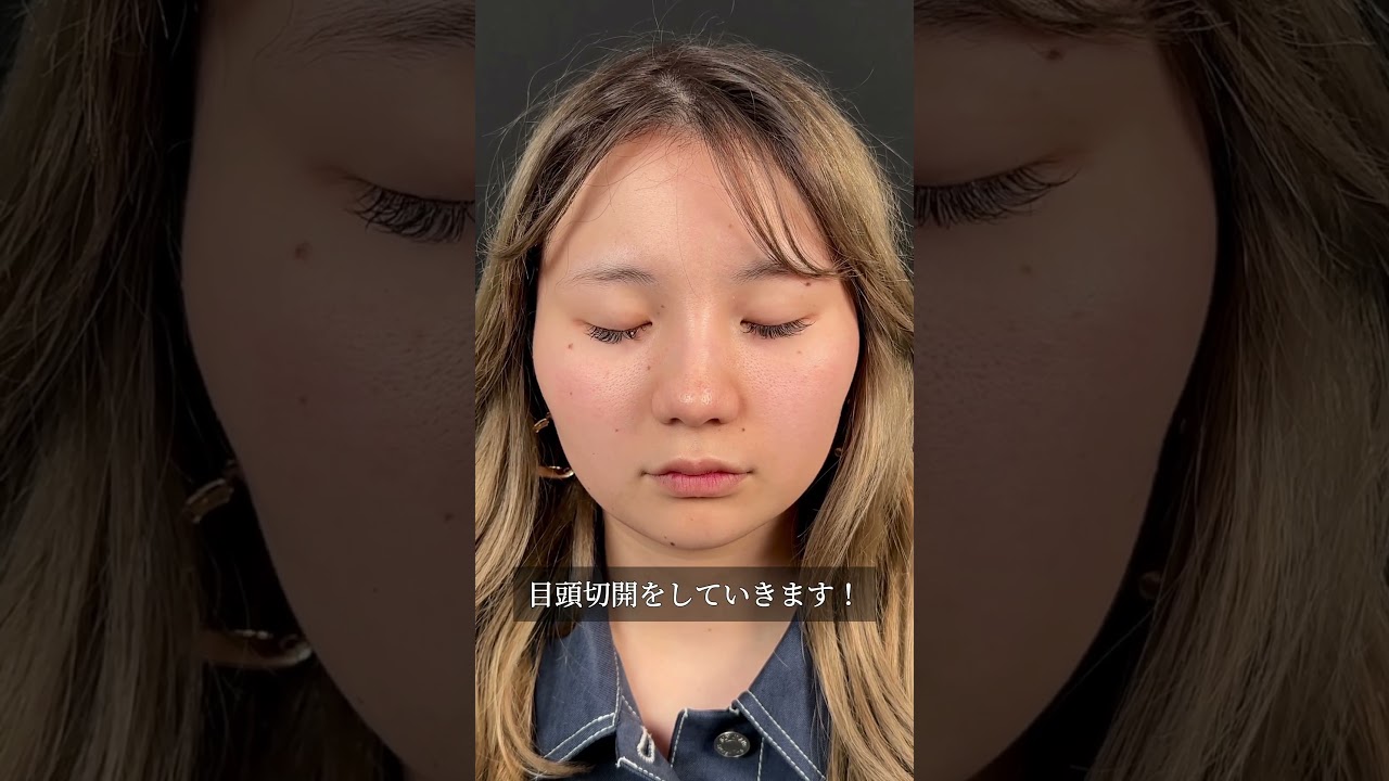 【目頭切開】衝撃の垢抜け！術後経過も公開！#美容整形 #美容外科 #美容クリニック #美容 #目頭切開