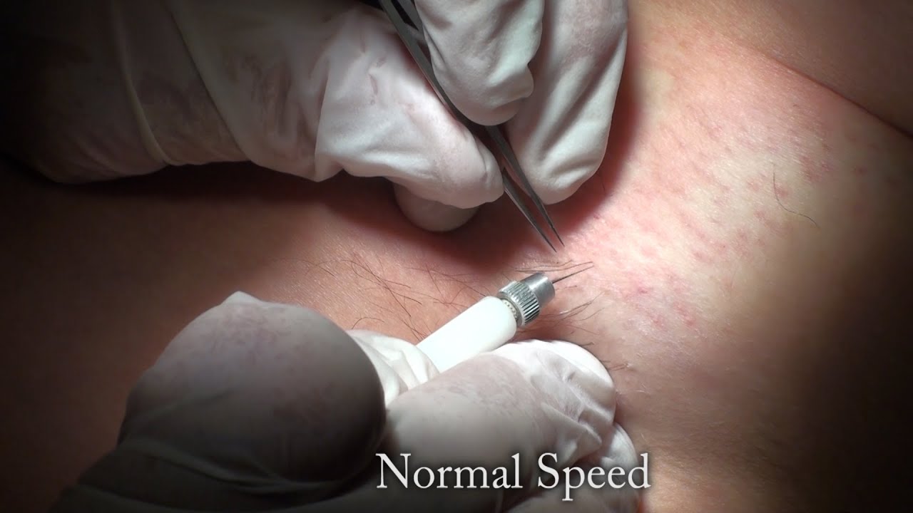 Armpit hair removal:  2 of 3
