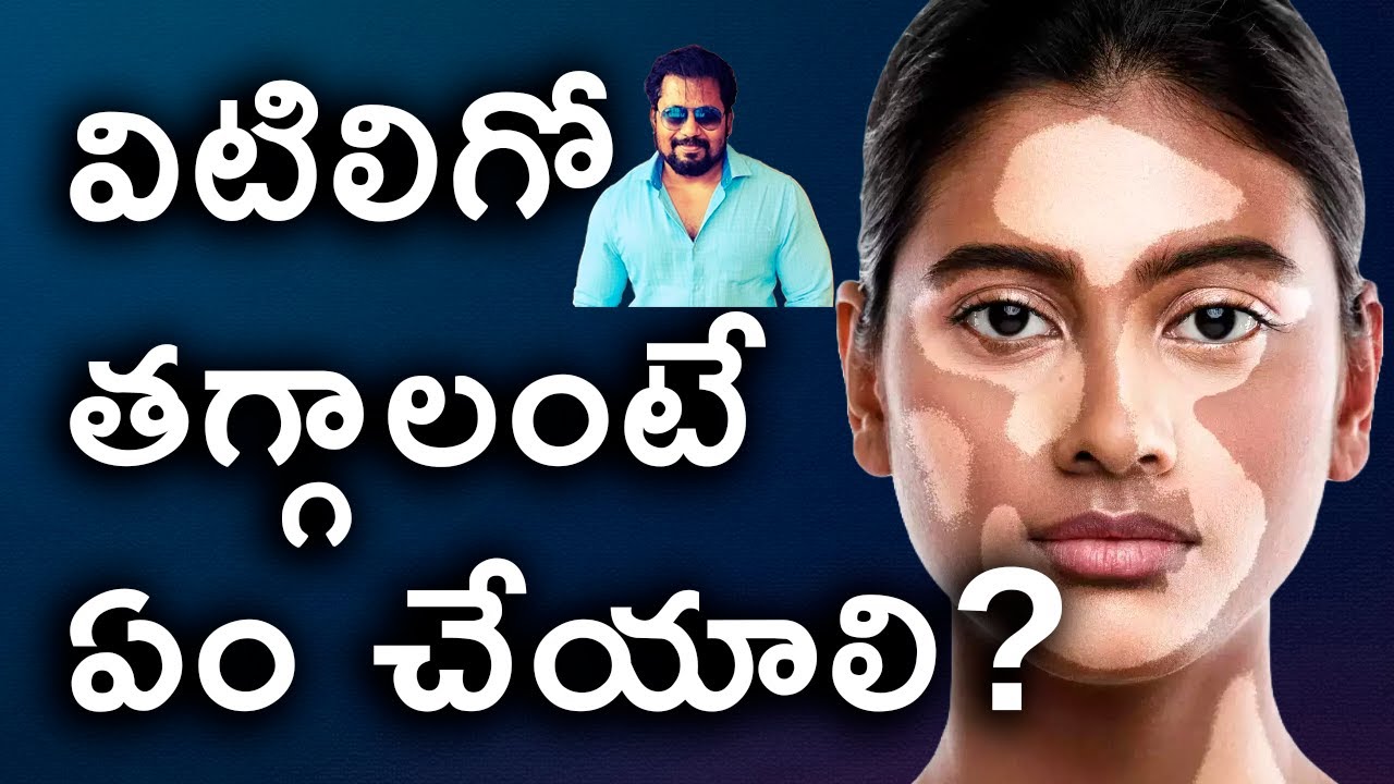 విటిలిగో తగ్గాలంటే ఏం చేయాలి? How to Cure Vitiligo?