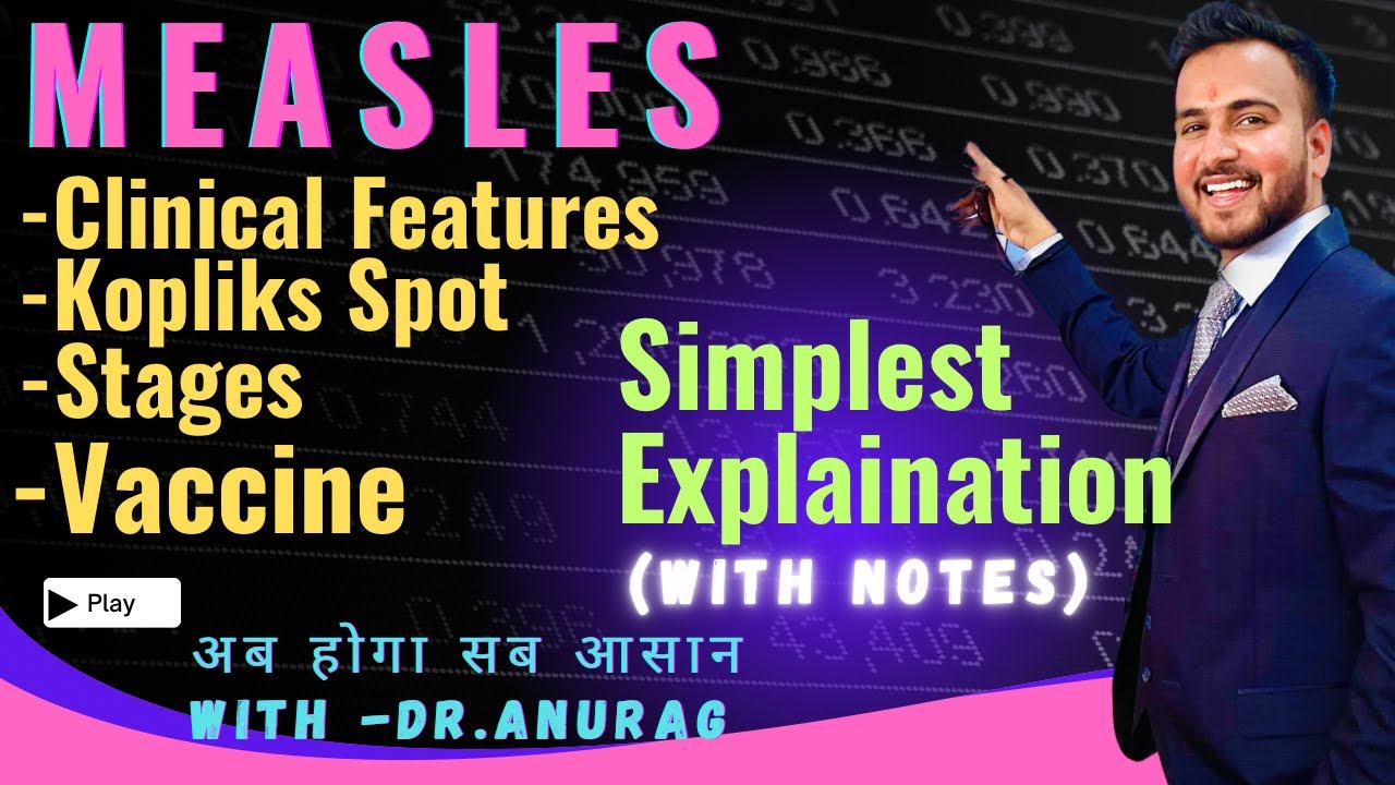 Measles//Causes//Sign & Symptoms//Complications//Vaccination//Treatment//Diagnosis