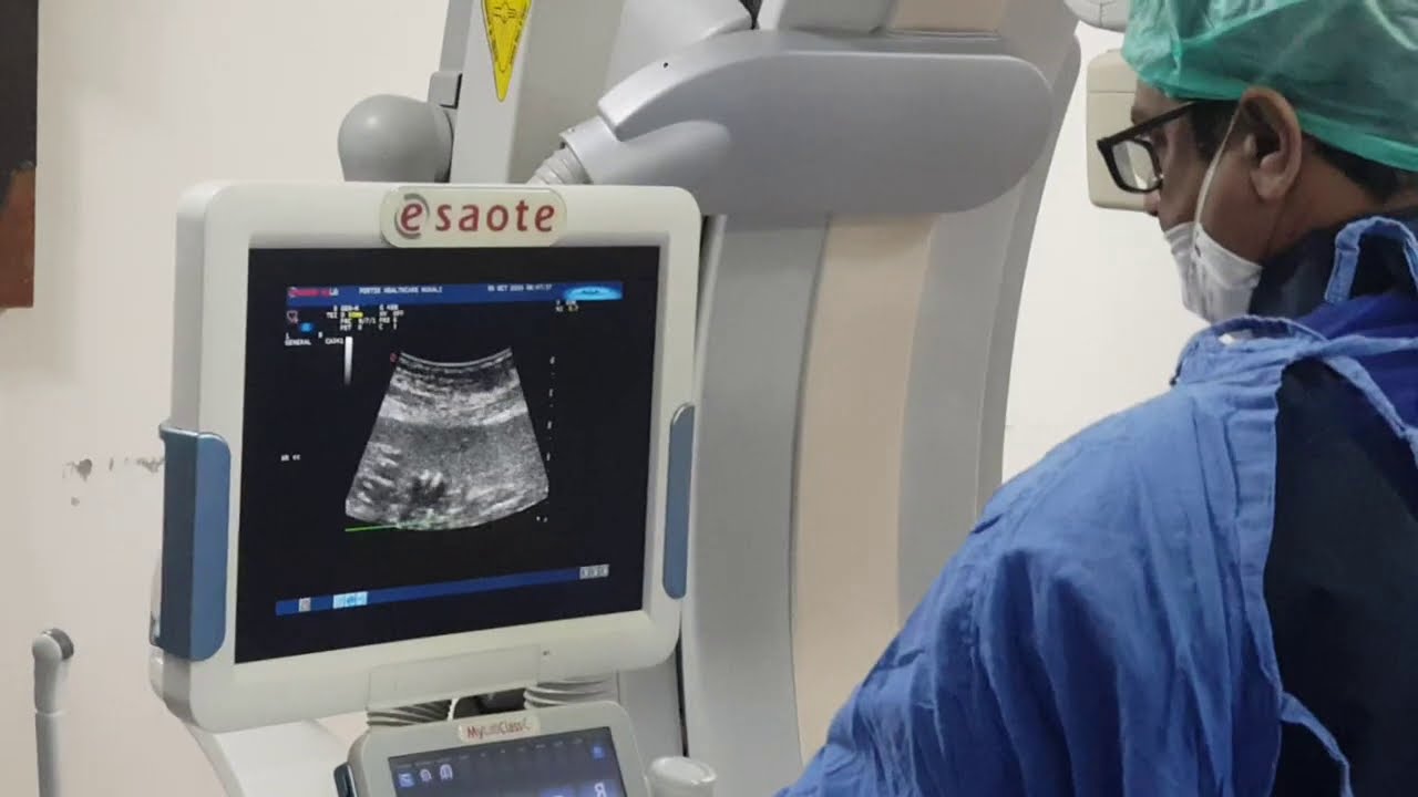 PTBD stenting for high complex Biliary block using double wire technique