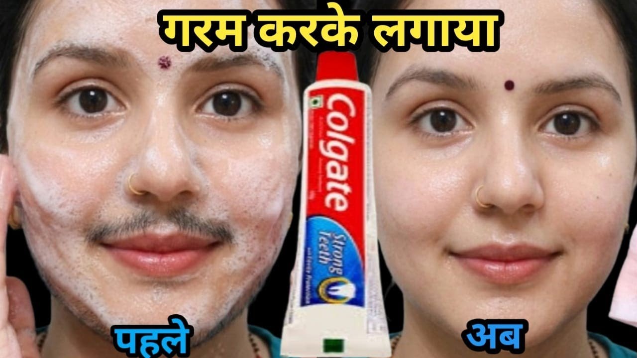 Vicks का क्रीम घर पे बना कर लगाओ तुरंत दाढ़ी मूछ साफ😱रिजल्ट देख कर हैरान || hair removal at home