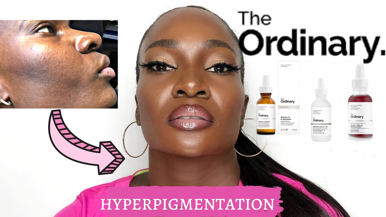 THE ORDINARY - Best products for hyperpigmentation , darkspots + textured skin