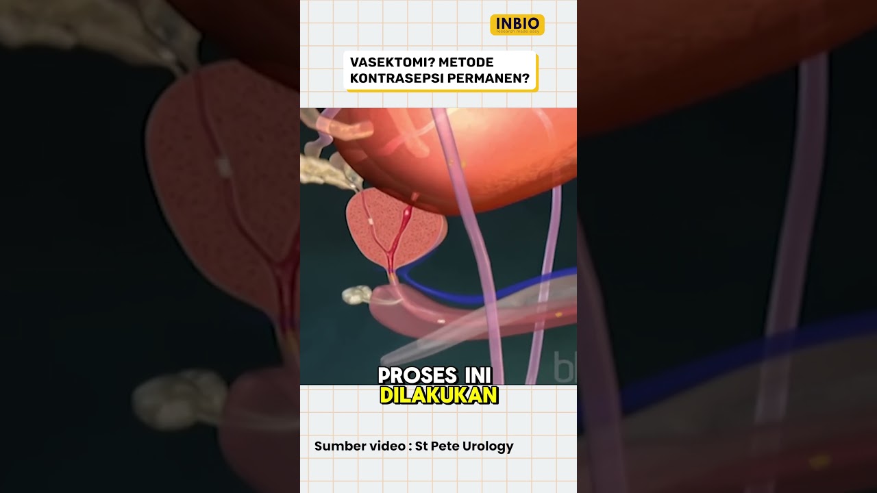 Vasektomi alat kontrasepsi permanen?