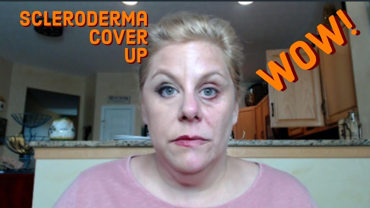 Dark Circle under eyes BEST Makeup EVER - Morphea - Scleroderma Concealer