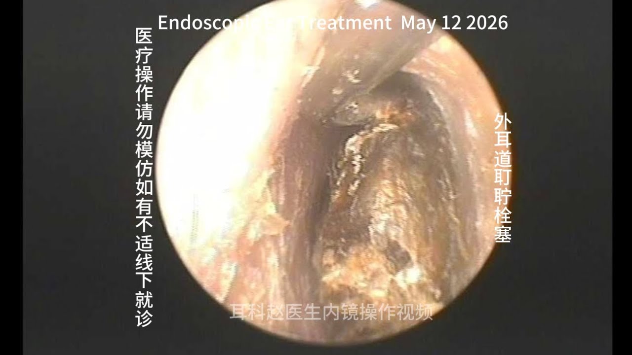 Removal of Earwax Blockage in the External Auditory Canal 20260512