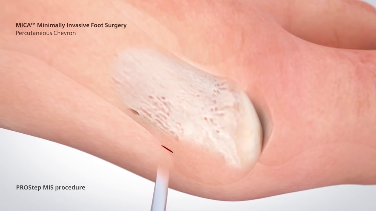 Minimally Invasive Bunion Surgery