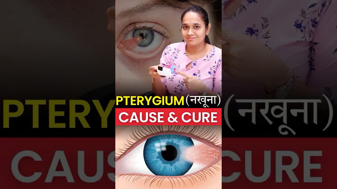 What Is Pterygium? Causes, Symptoms & Cure