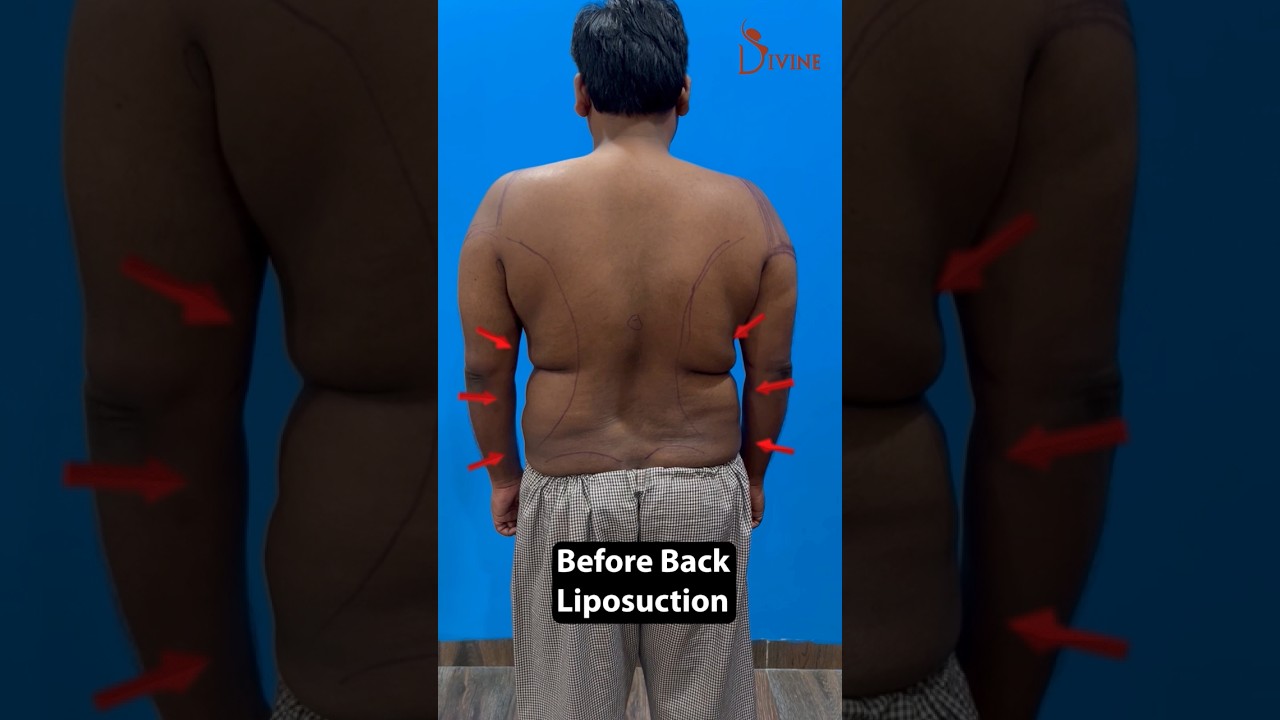Male Back Liposuction Result | Back Fat Removal at Divine #shortsfeed