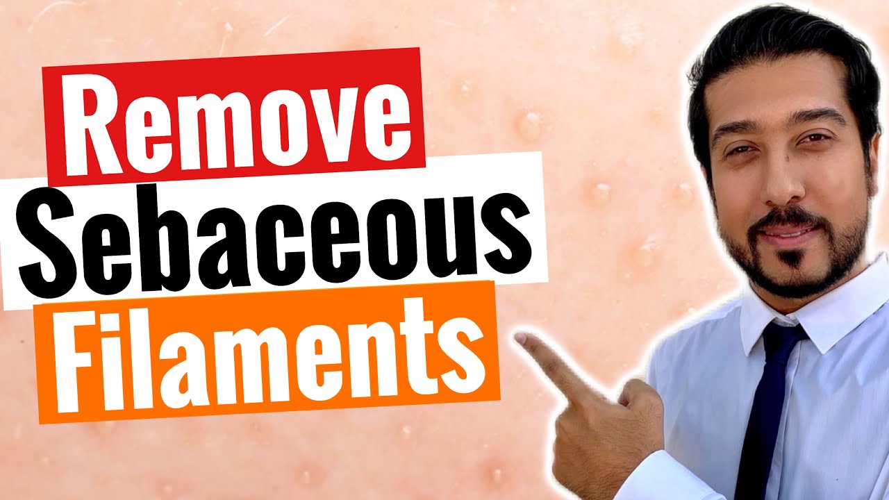 Sebaceous Filaments | 3 Steps to Get Rid of Sebaceous Filaments FAST