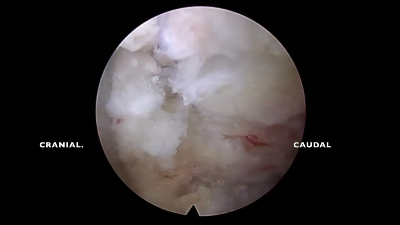 FULL ENDOSCOPIC FORAMINOPLASTY and Discectomy for Recurrent Lumbar Disc Prolapse