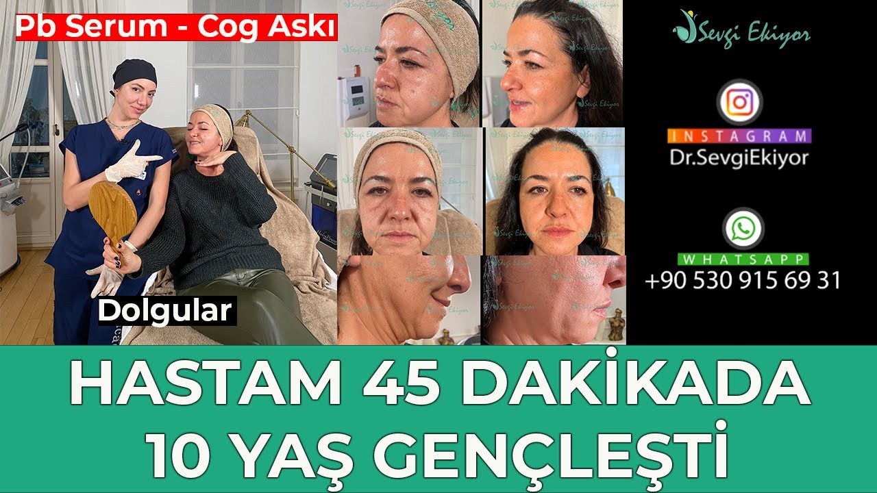Pb Serum - Cog İp Askı Ve Dolgularla Hastam 45 Dakikada 10 Yaş Gen&ccedil;leşti