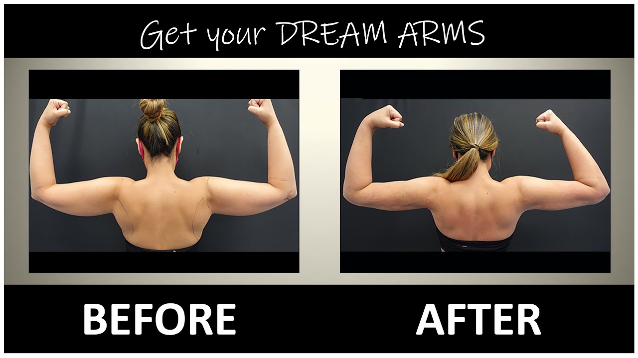 Arm Liposuction Immediate Results | Celebrity Arms&trade; | Lipo 360&deg; Arms |High-Definition |Expert Dr. Su