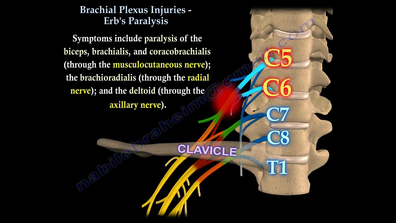 Brachial Plexus Injuries: Erb’s & Klumpke’s Palsy