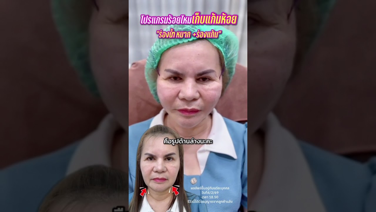 ร้อยไหมที่นารีญาคลินิก จองคิวหรือวอคอินเข้าทำได้ทุกวัน #นารีญาคลินิกรีวิว #ร้อยไหม #ปรึกษาฟรี 