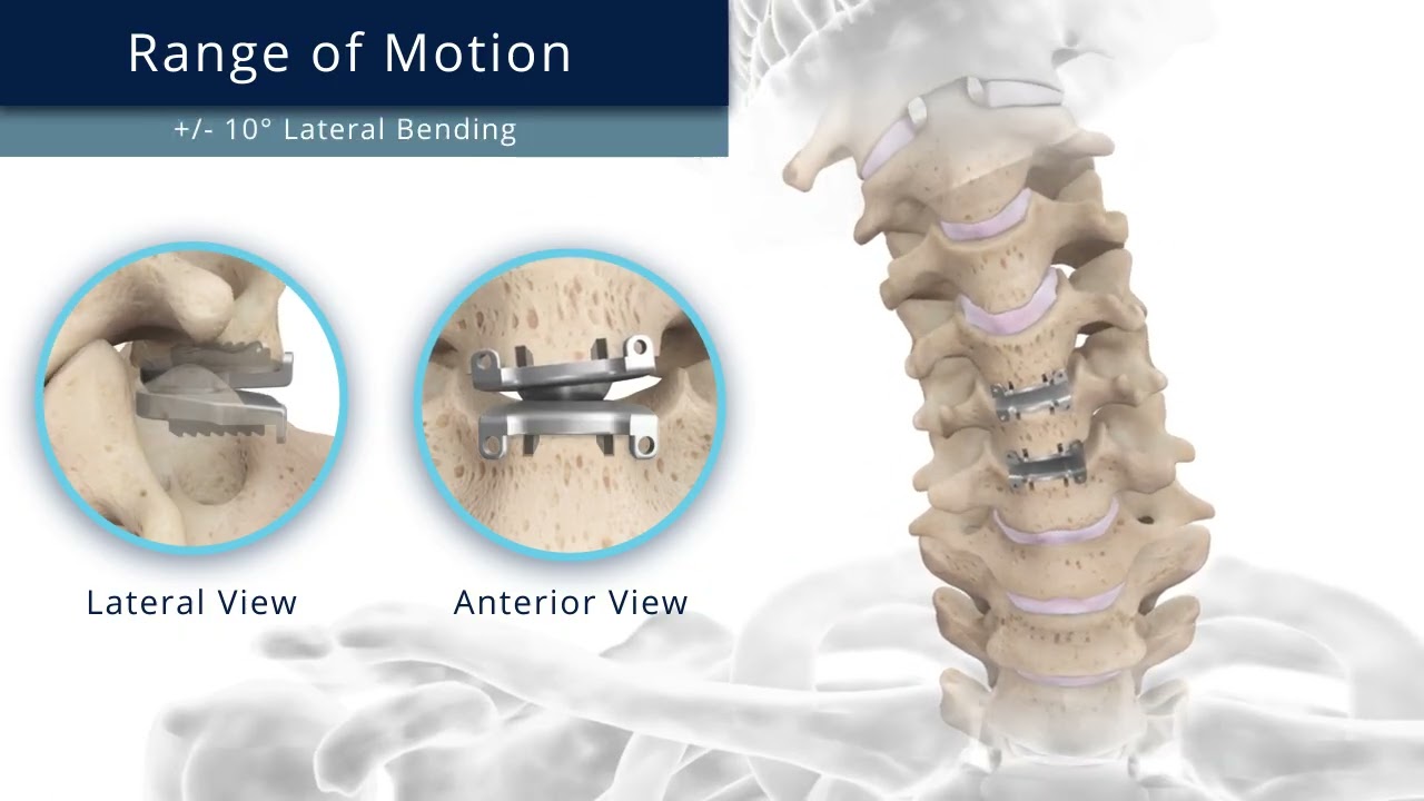 Medtronic Spine Features and Benefits | 3D Medical Animation by Pulse 3D Media
